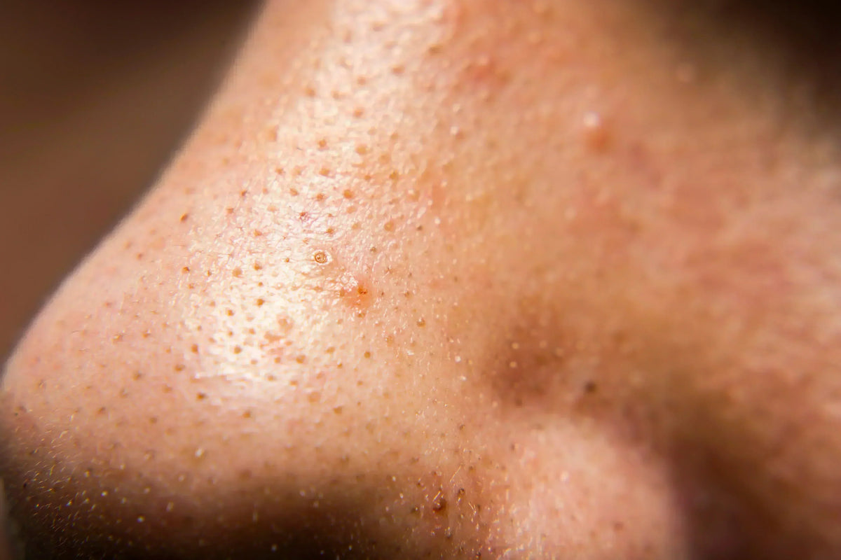 Why Your Pores Keep Getting Clogged: 10 Causes & How to Prevent Them