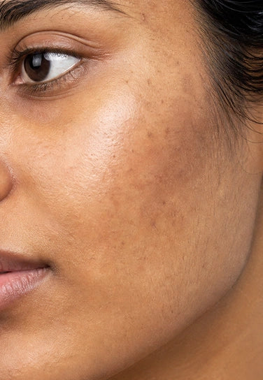 The Science Behind Uneven Skin Tone: Causes, Melanin, Dark Spots & Skincare Routine