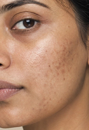 Why Do Acne Marks Stay for So Long? Causes, Prevention & How to Fade Them