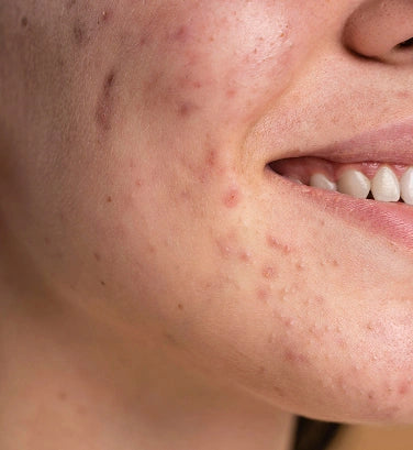 Why Does Acne Get Worse Before Your Period? A Guide to Period Acne