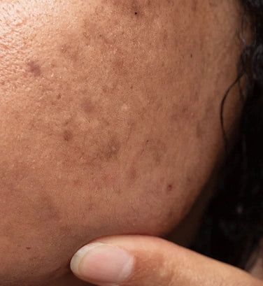 Why Do Dark Spots Look Darker After Sun? The Acne-Mark Mistake Most People Miss