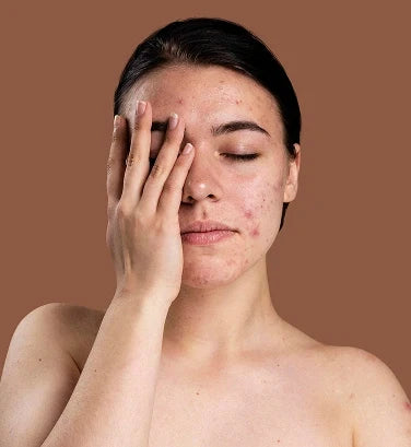 Acne Face Mapping: What Pimples on Your Forehead, Cheeks, Chin & Jawline Really Mean