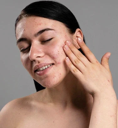 Is Your Phone Causing Acne? 7 Everyday Things Touching Your Face That May Trigger Breakouts