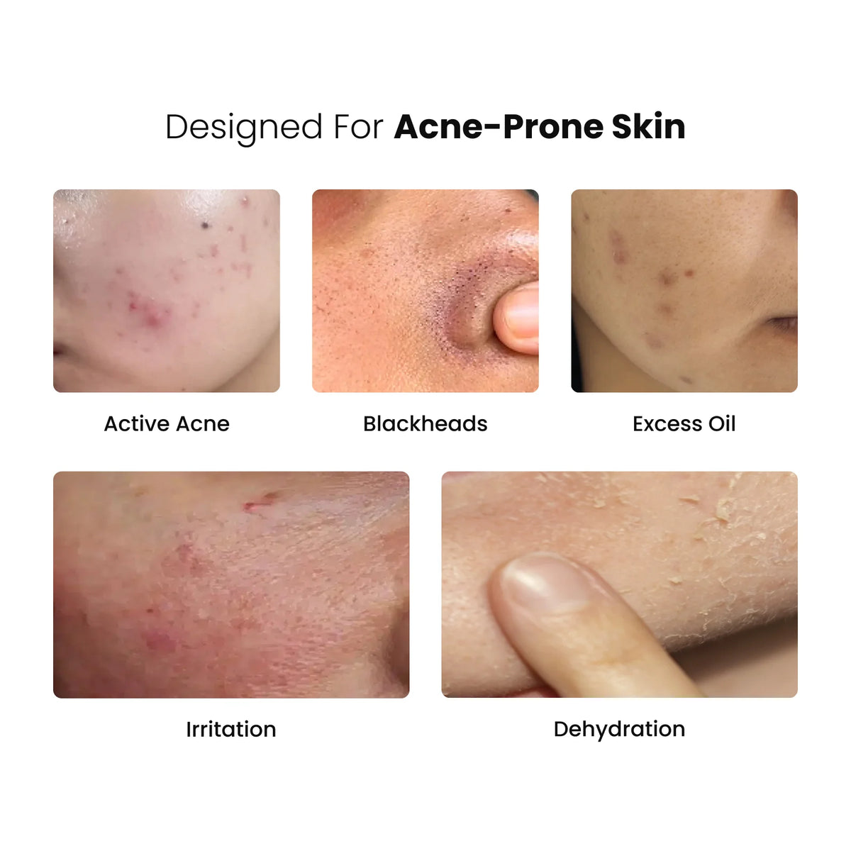 Anti-Acne Daily Skin Care Routine Combo