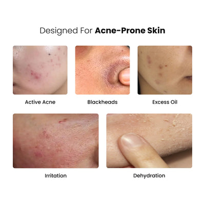 Anti-Acne Daily Skin Care Routine Combo