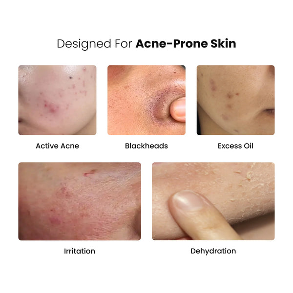 Anti-Acne Daily Skin Care Routine Combo