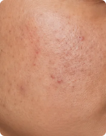 Reduces Acne-Causing Buildup