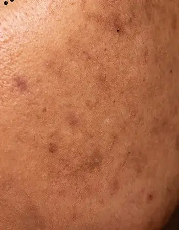 Pigmentation & Dark Spots