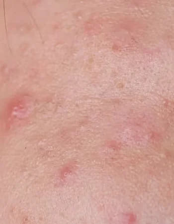 Acne & Breakouts