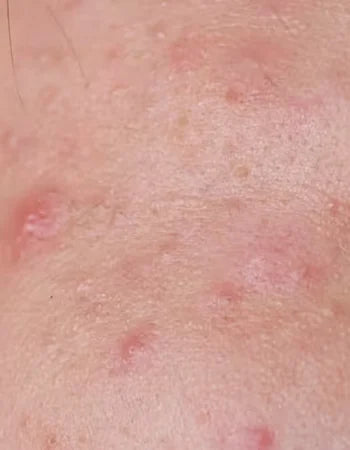 Acne & Breakouts