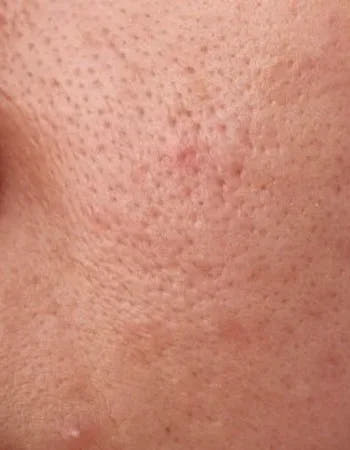 Deeply CleansesPores