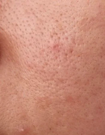 Deeply CleansesPores