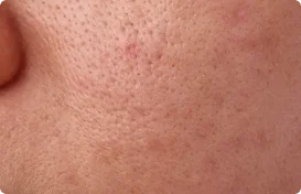 Deeply  CleansesPores