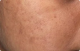 Improve The Look Of Post-Acne Marks