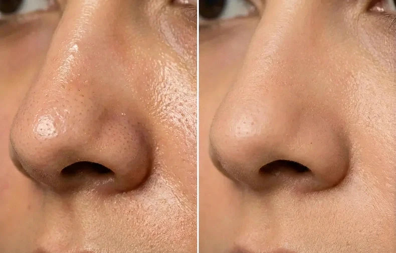 Pores