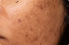Reduce Visible Dark Spots