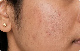 Reduces Acne-Causing Buildup